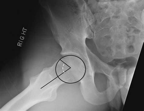 acetabular labral test results